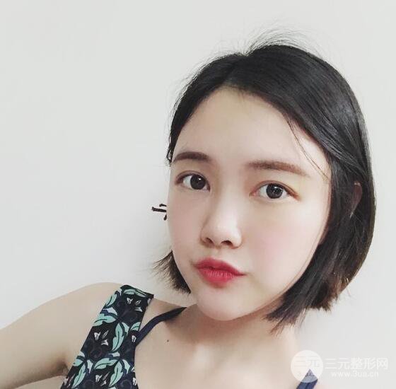 上海華美李健自體脂肪詳細(xì)部填充果圖，少女臉經(jīng)久不衰的秘密在這里