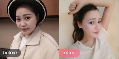 隆鼻整形,包括墊高鼻梁,縮小鼻翼,這是隆鼻整形前后對比圖