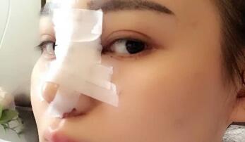 隆鼻整形恢復(fù)圖