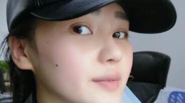 做完隆鼻整形后天天都盼著拆紗布,第3天終于拆了