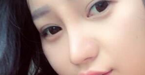 四川嬌點(diǎn)整形醫(yī)院姜宇祿院長給我做的隆鼻整形