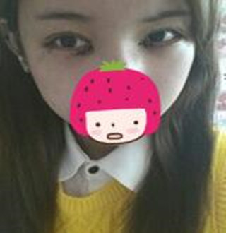 一起來(lái)評(píng)價(jià)一下重慶愛(ài)思特盧剛醫(yī)生做的切開(kāi)雙眼皮吧