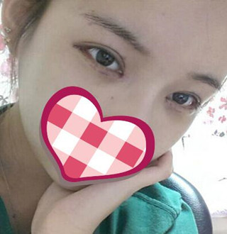 一起來(lái)評(píng)價(jià)一下重慶愛(ài)思特盧剛醫(yī)生做的切開(kāi)雙眼皮吧