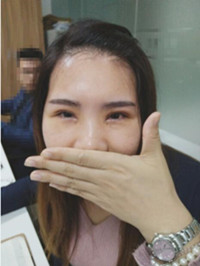 于利民醫(yī)生讓我基本和單眼皮說(shuō)“拜拜”