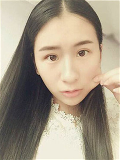 大家看看盧剛給我做的膨體墊下巴怎么樣