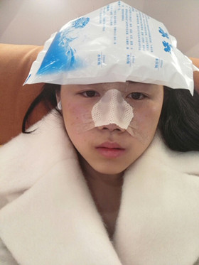 于立民醫(yī)生給我做的隆鼻整形手術(shù)，給大家分享我整形的過(guò)程吧!