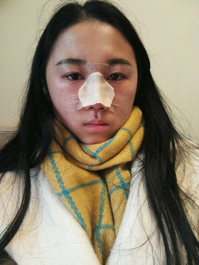 于立民醫(yī)生給我做的隆鼻整形手術(shù)，給大家分享我整形的過(guò)程吧!