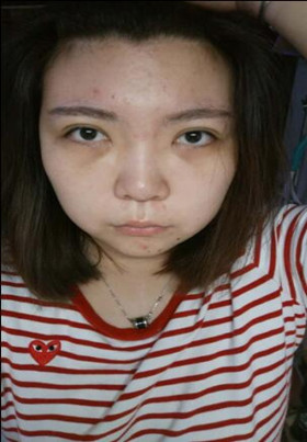 激光去眼袋后，整個人都年輕了不少啊!