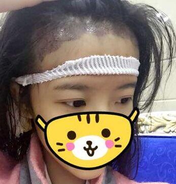 成都玉之光發(fā)際線種植 果不錯~