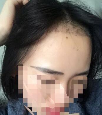 成都玉之光頭發(fā)移植 果杠杠的~