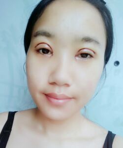 煙臺(tái)鵬愛(ài)魏璐做的全切雙眼皮，我也是大眼美女了