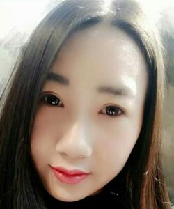 煙臺(tái)鵬愛(ài)魏璐做的全切雙眼皮，我也是大眼美女了