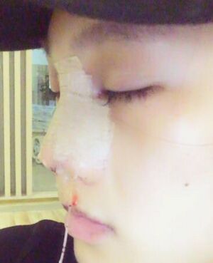 趙煜楠給做的隆鼻整形，看看我鼻子果怎么樣