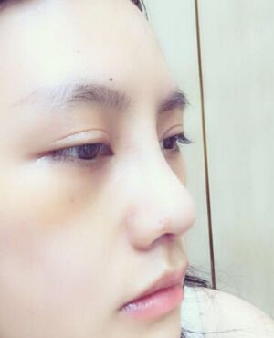 趙煜楠給做的隆鼻整形，看看我鼻子果怎么樣