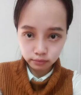 全切雙眼皮+去脂肪，終于擺脫小眼睛了