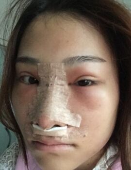 硅膠隆鼻還墊鼻尖了，甘泉涌做的果真的很好喲