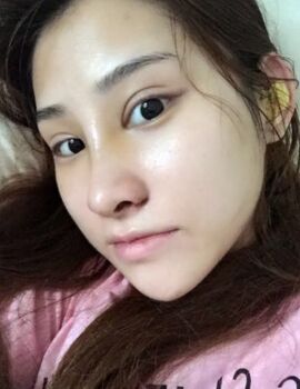 硅膠隆鼻還墊鼻尖了，甘泉涌做的果真的很好喲