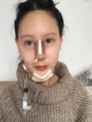 成都天使之翼做隆鼻整形改變了我的塌鼻子 果真的很不錯