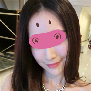 黃慶武醫(yī)生做的音波拉皮除皺手術(shù)分享，有很多前后對(duì)比果圖片哦~~~