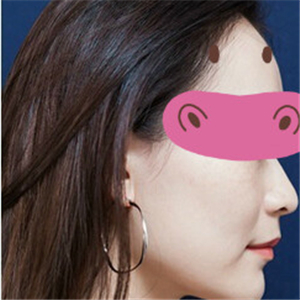 黃慶武醫(yī)生做的音波拉皮除皺手術(shù)分享，有很多前后對(duì)比果圖片哦~~~