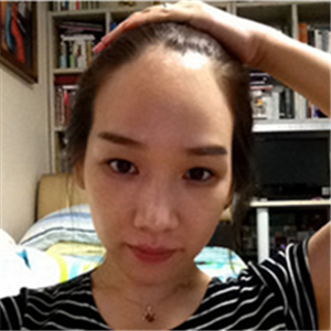 去年在格萊美做了頭發(fā)種植，看看前后對(duì)比和恢復(fù)果照片吧~~