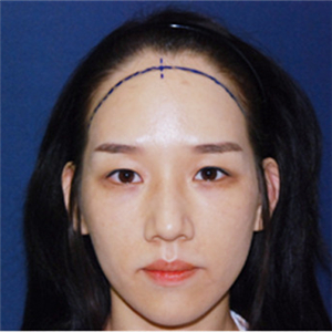 去年在格萊美做了頭發(fā)種植，看看前后對(duì)比和恢復(fù)果照片吧~~