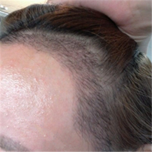 分享我頭發(fā)種植前后和恢復(fù)過程的圖片，是格萊美黃興勇做的哦~~~