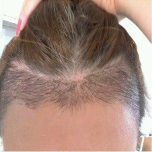 分享我頭發(fā)種植前后和恢復(fù)過程的圖片，是格萊美黃興勇做的哦~~~