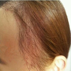 分享我頭發(fā)種植前后和恢復(fù)過程的圖片，是格萊美黃興勇做的哦~~~