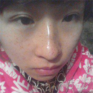 去格萊美做了激光去雀斑，有恢復(fù)前后的對(duì)比照片哦，還不錯(cuò)~~