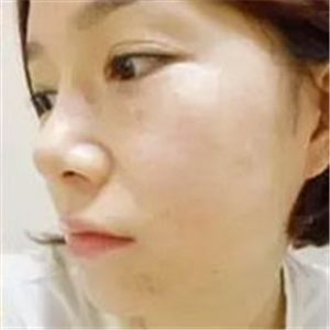 做了激光去雀斑前后對(duì)比照片分享，黃俊俊的技術(shù)很好哦！