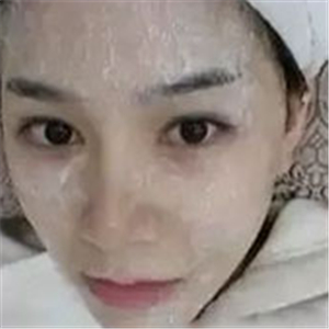 做了激光去雀斑前后對(duì)比照片分享，黃俊俊的技術(shù)很好哦！