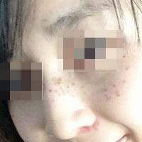 花費4000元做了激光祛斑，終于把雀斑消滅了555555