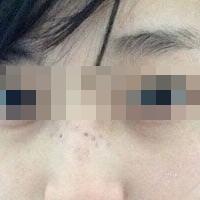 花費4000元做了激光祛斑，終于把雀斑消滅了555555