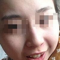 花費4000元做了激光祛斑，終于把雀斑消滅了555555