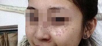 花費4000元做了激光祛斑,終于把雀斑消滅了