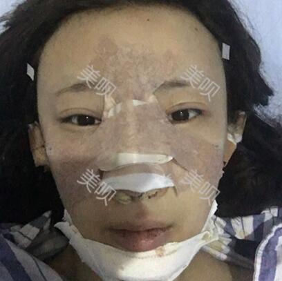 在成都天使之翼自體脂肪面部填充大家看看果怎么樣