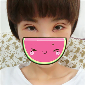 做park法雙眼皮手術(shù)一個月了，果很好，有恢復(fù)過程照片哦~~