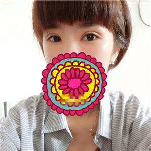 做park法雙眼皮手術(shù)一個月了，果很好，有恢復(fù)過程照片哦~~