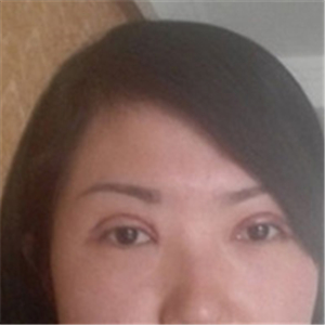 楊亞益醫(yī)生做的雙眼皮+開眼角，果不錯，看看我的恢復(fù)照片~~~