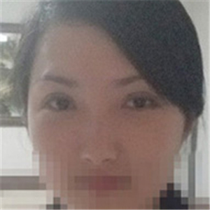 楊亞益醫(yī)生做的雙眼皮+開眼角，果不錯，看看我的恢復(fù)照片~~~