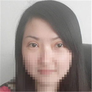 楊亞益醫(yī)生做的雙眼皮+開眼角，果不錯，看看我的恢復(fù)照片~~~