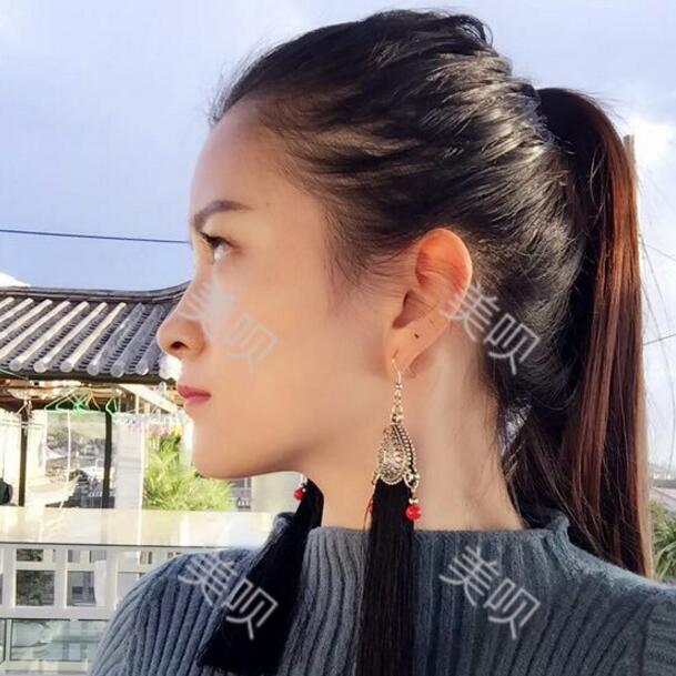 我做了玻尿酸隆鼻后被同學叫網(wǎng)紅哈哈~~~