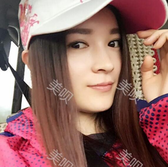 我做了玻尿酸隆鼻后被同學叫網(wǎng)紅哈哈~~~