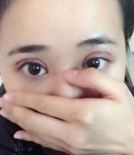 北京常好麗格割雙眼皮一周啦~