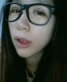 北京常好麗格三點(diǎn)定位雙眼皮恢復(fù)一個(gè)月經(jīng)歷