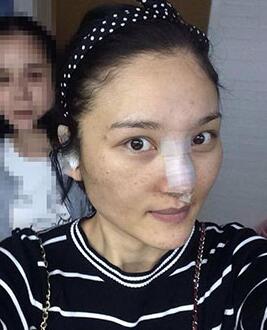 北京常好麗格做假體隆鼻3個(gè)月