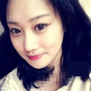 看看我磨下頜角整形手術(shù)恢復(fù)前后的對比圖片，同學(xué)都說我像張馨予~~