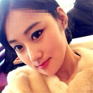 看看我磨下頜角整形手術(shù)恢復(fù)前后的對比圖片，同學(xué)都說我像張馨予~~