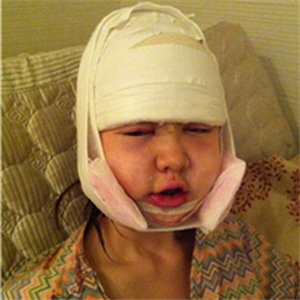 上海華美李志海做的v－line瓜子臉手術(shù)，果太好了~哈哈哈~